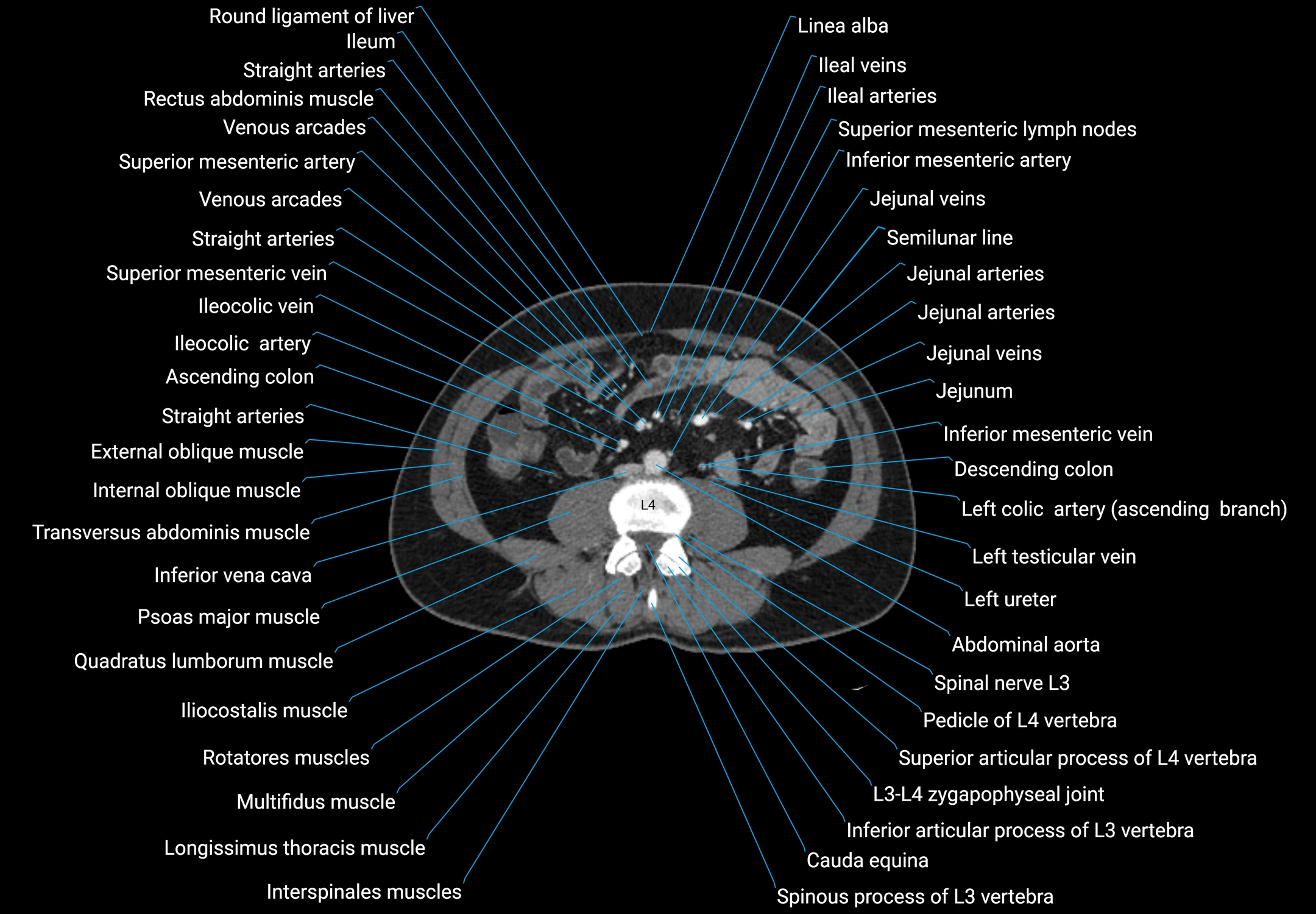 CT male pelvis axial cross sectional anatomy labelled radiology image -00102.webp